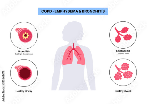 Chronic obstructive pulmonary disease