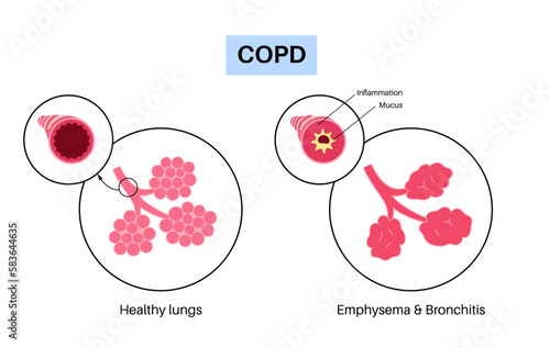 Chronic obstructive pulmonary disease