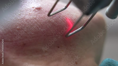 Extreme close up shot of Beautician cosmetologist doing procedure fractional microneedle mesotherapy rejuvenation with laser technology. Hardware cosmetology in clinic salon for client.