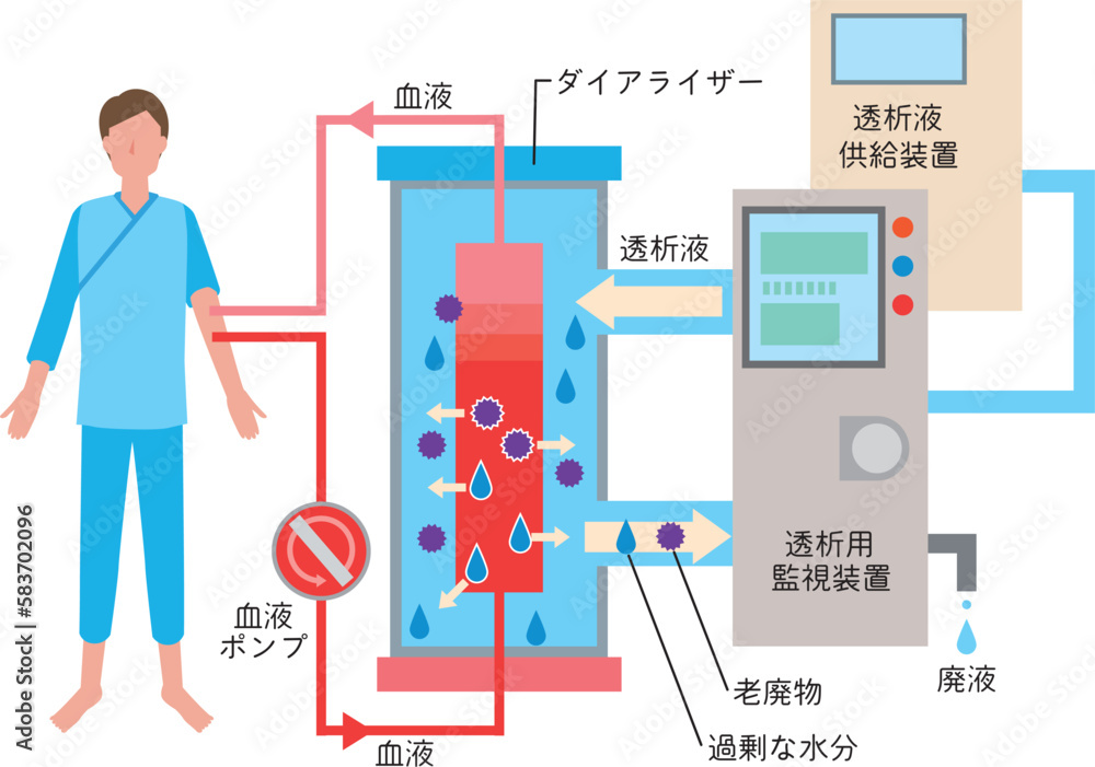 人工透析治療のイメージイラスト 人工透析治療のイメージイラスト