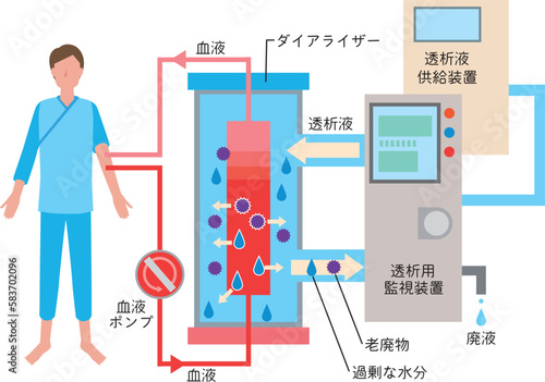 人工透析治療のイメージイラスト