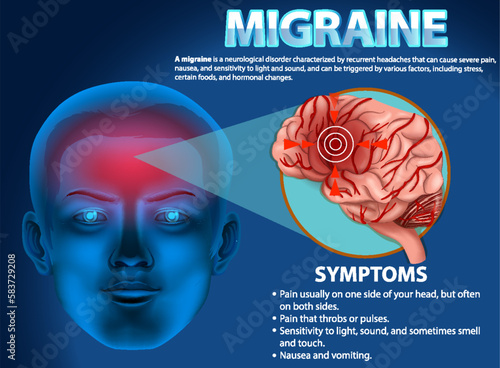 Informative poster of Migraine