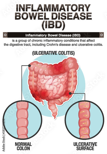 Inflammatory Bowel Disease (IBD) Infographic