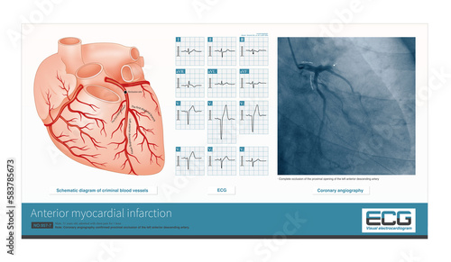 The proximal occlusion of the left anterior descending artery leads to a large area of anterior myocardial infarction, which belongs to the high occlusion of the left coronary artery.