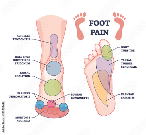 Foot pain causes from zones diagnosis and painful spots areas outline diagram. Labeled educational scheme with medical illness, disease or trauma diagnostics vector illustration. Tendonitis, bursitis photo