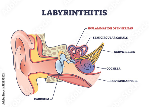 Labyrinthitis as inner ear infection and medical inflammation outline diagram. Labeled educational scheme with painful condition and medical cause for hearing and balance loss vector illustration.