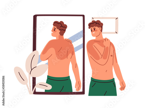 Man with reddish body after sun UV, looking at skin sunburns in mirror. Suntan burns problem on body. Sad person with burnt spots. Flat graphic vector illustration isolated on white background