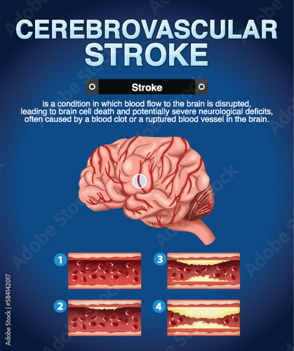 Informative poster of Cerebrovascular stroke
