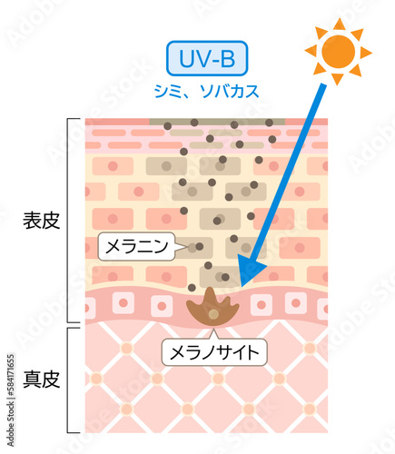 紫外線　UV-B　紫外線B波　肌の断面図　