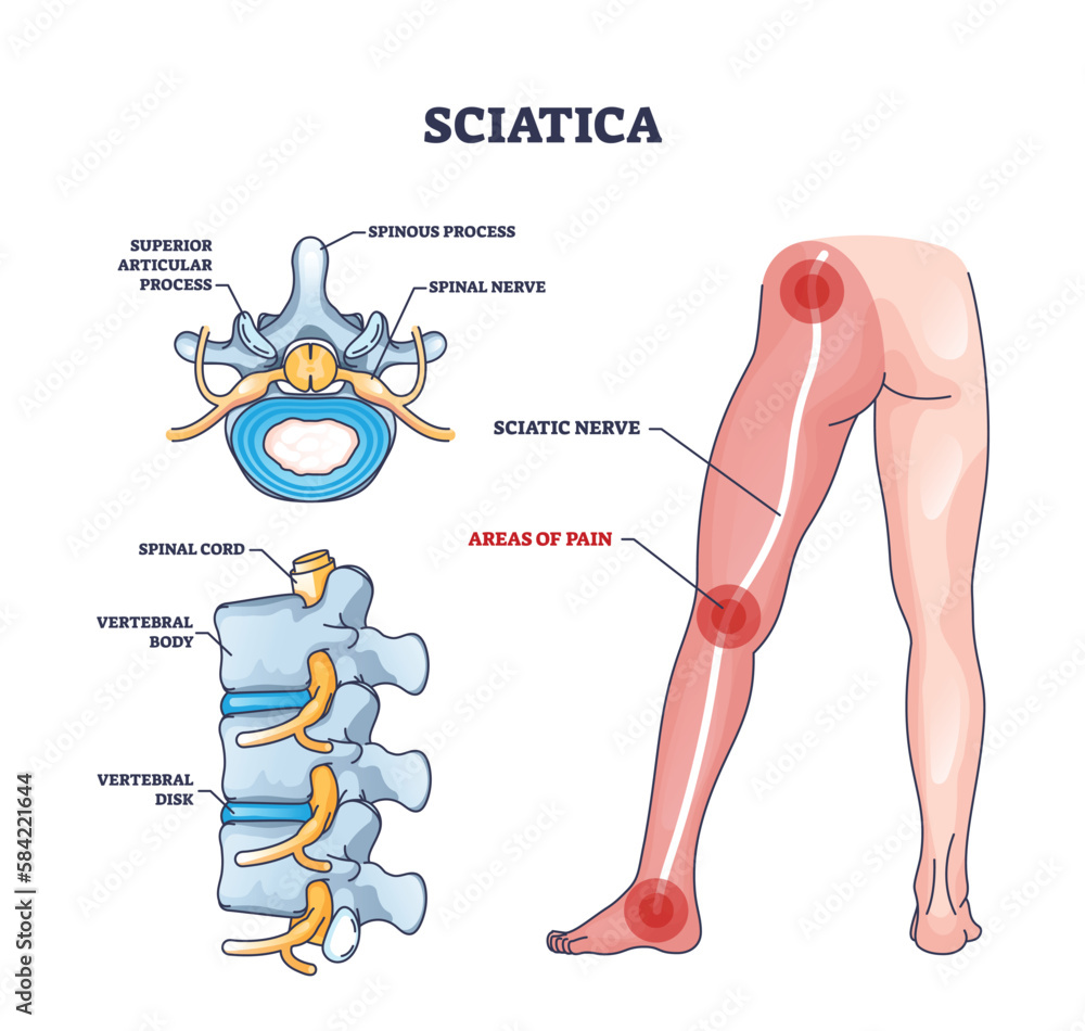 Poster Sciatica Areas Of Pain With Anatomical Location On Leg Outline 