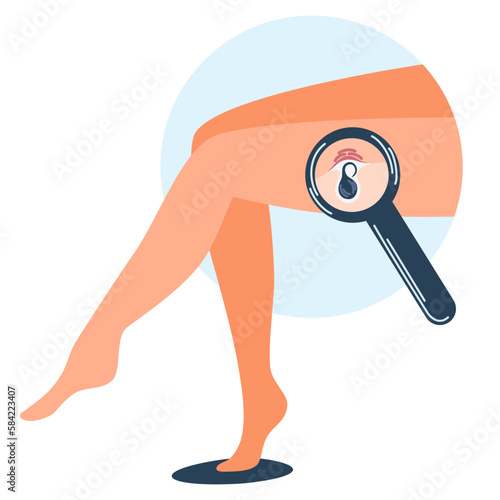 Women's legs with ingrown hairs. Ingrown hairs. Skin problem, Inflammation. Comedones and clogged pores. Magnifier zooms inflammation follicle. Vector illustration 