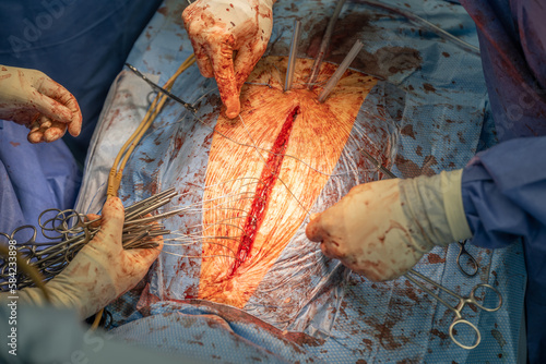 Two heart surgeons close the chest with wires after a bypass operation. Concept: health and cardiac surgeon