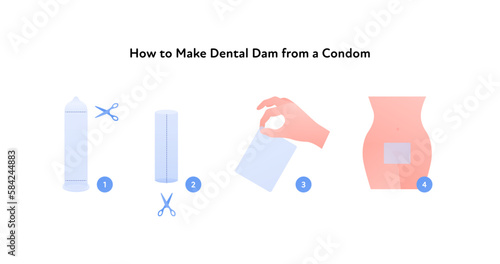 Sexual transmitted disease infographic. Vector flat healthcare illustration set. STD infection protection. How to make dental dam from condom symbol. Design for health care, sex education