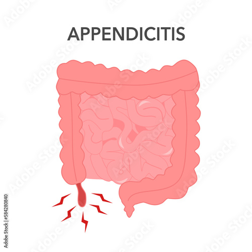 Appendicitis concept vector illustration. Inflammation of appendix.