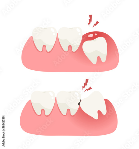 Illustration of wisdom tooth under gum cause of pain and lean on other teeth cause of tooth decay. Concept of pain in mouth, toothache, impacted tooth, oral and dental health, dentistry. Flat vector.