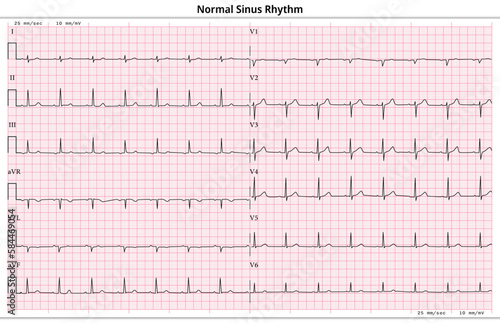 ECG Normal Sinus Rhythm - 12 Lead ECG Common Case - 6 Sec/lead - Vector Medical Illustration