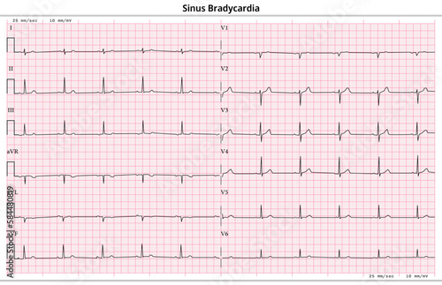 ECG Sinus Bradycardia - 12 Lead ECG Common Case - 6 Sec/lead - Vector Illustration