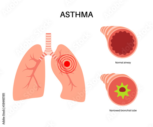 Asthma lung disease