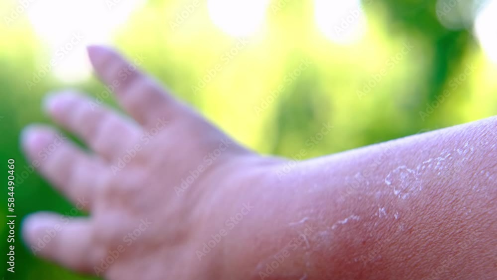 sunburn on skin, exfoliation of epithelium, severe peeling of the skin