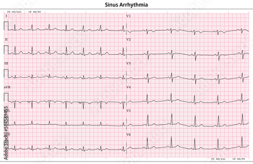 ECG Sinus Arrhythmia - 12 Lead ECG Common Case - 6 Sec/lead - Vector Illustration