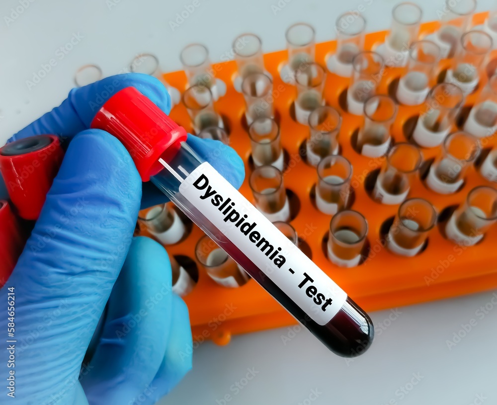 Obraz premium Blood sample for Dyslipidemia test. Dyslipoproteinemia. Hyperlipidemia. Lipid profile.