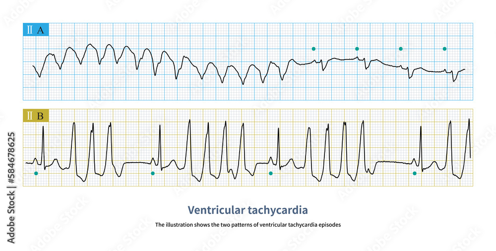 The illustration shows the two patterns of VT episodes.The green circle represents sinus rhythm. Picture A shows paroxysmal episodes of VT a, and picture B shows short bursts.