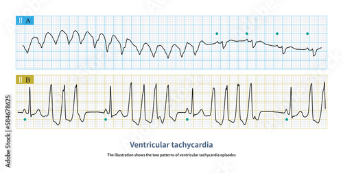 The illustration shows the two patterns of VT episodes.The green circle represents sinus rhythm. Picture A shows paroxysmal episodes of VT a, and picture B shows short bursts.