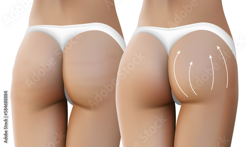 Fotografie Female Lifting Before And After Plastic Surgery