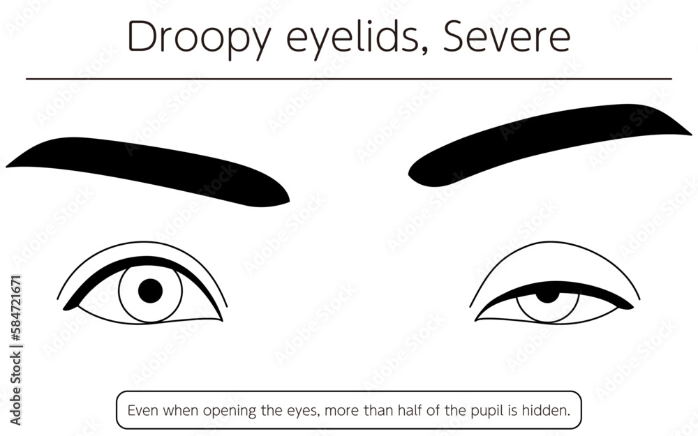 Medical illustration Diagram of severe ptosis (eyelid drooping) Stock Vector Adobe Stock