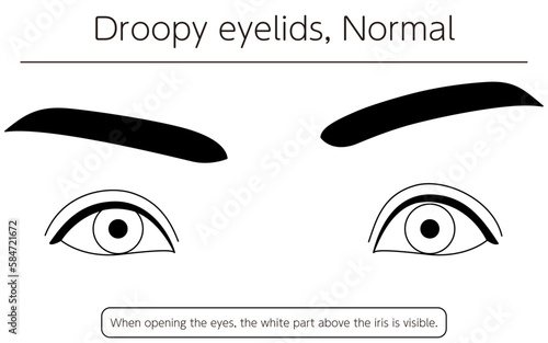 Medical illustration: Diagram of normal state of ptosis (eyelid drooping)