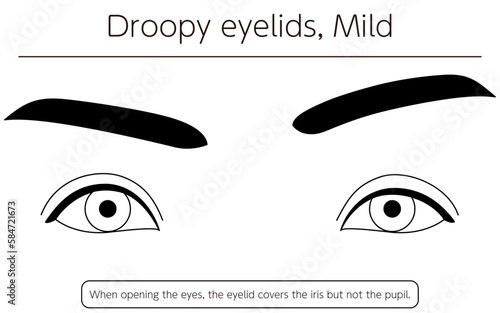 Medical illustration: Diagram of mild ptosis (eyelid drooping)