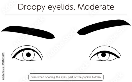 Medical illustration: Diagram of moderate ptosis (eyelid drooping)
