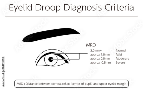 Medical illustration: Diagram of severe ptosis (eyelid drooping)