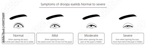 Medical Illustration, Ptosis Symptoms Normal to Severe