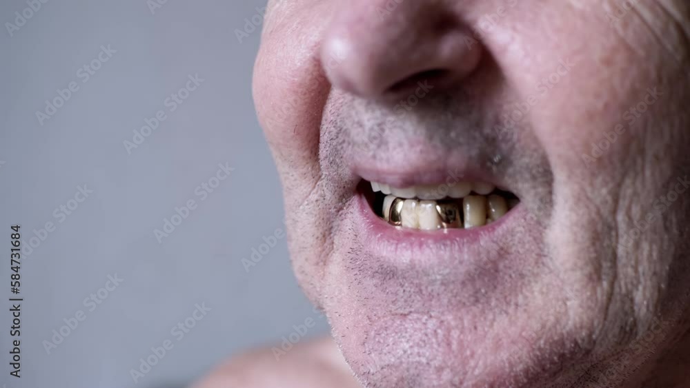 Close up, Smiling Elderly Male Pensioner with False Dentures and Golden Teeth. Wrinkled, unshaven face of an old man with white dental implants, and an artificial upper jaw in mouth. Part of face. Close up, Smiling Elderly Male Pensioner with False Dentures and Golden Teeth. Wrinkled, unshaven face of an old man with white dental implants, and an artificial upper jaw in mouth. Part of face.