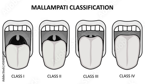 Mallampati Classification - Oral Airway Assessment
