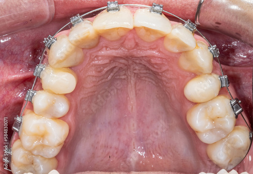 Dental orthodontics patient. Indirect occlusal view of the maxillary arch with metal brackets and metallic string. Gingiva gum, cheek retractor and moustache hair. photo