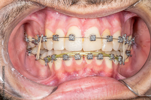 Dental orthodontics patient case man. Front view of arcades in occlusion with metal brackets and metallic string and elastic intermaxillary chains. Gingiva gum, cheek retractor and moustache hair.