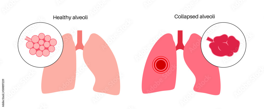 Emphysema anatomical poster - obrazy, fototapety, plakaty 