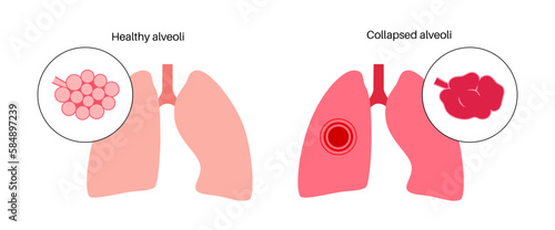 Emphysema anatomical poster