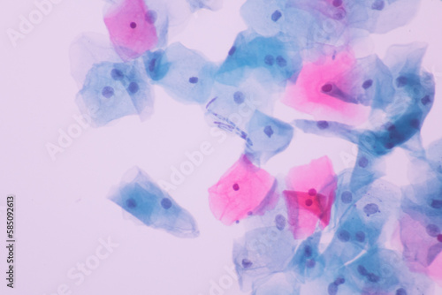 View in microscopic of Candidiasis, fungus infection (Yeast and Pseudohyphae form) in pap smear slide cytology and diagnostic by pathologist.Gynecology report and diagnosis.Sexually transmitted.