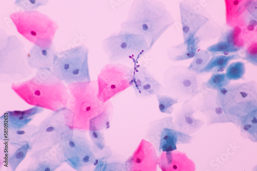 View in microscopic of Candidiasis, fungus infection (Yeast and Pseudohyphae form) in pap smear slide cytology and diagnostic by pathologist.Gynecology report and diagnosis.Sexually transmitted infect photo