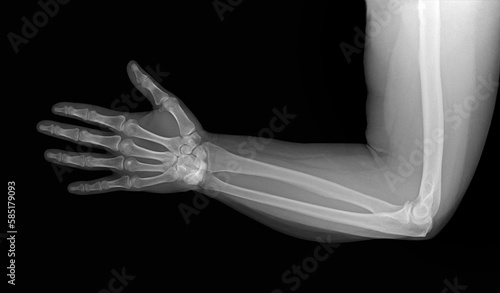 X-ray image of the elbow joint, without visible traumatic and bone-destructive changes.