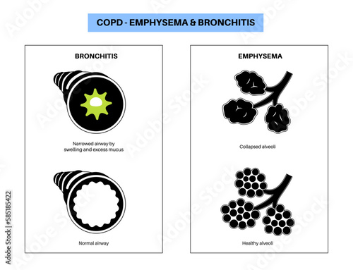 Chronic obstructive pulmonary disease