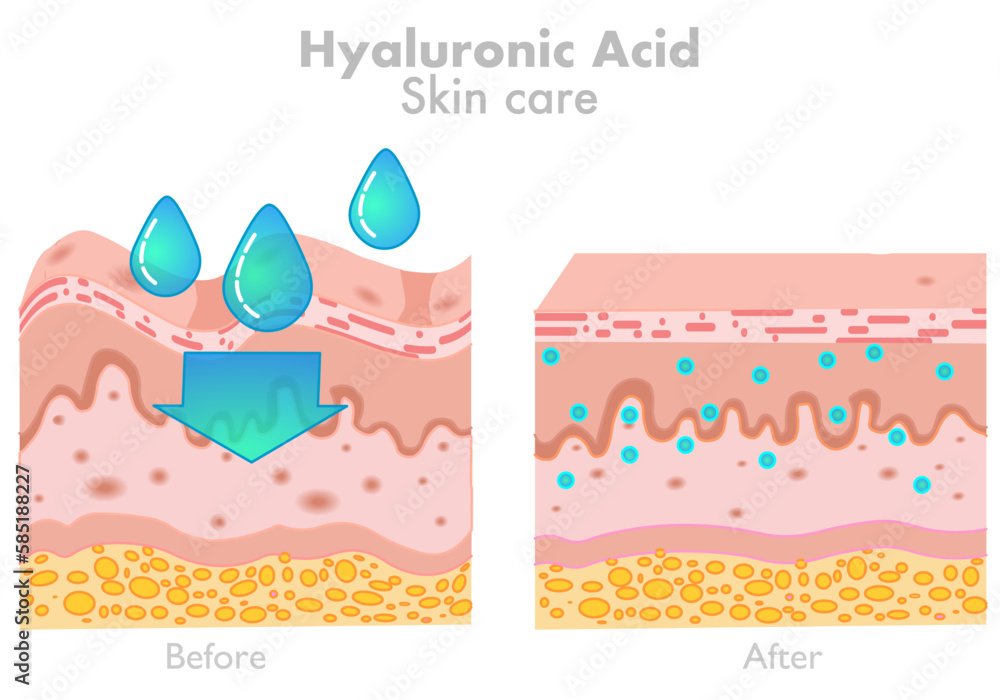 Hyaluronic acid, skin care. Before after products. HA absorb