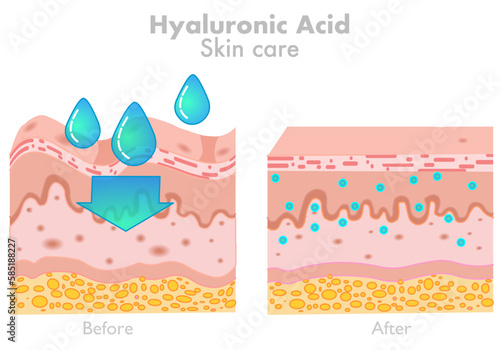 Hyaluronic acid, skin care. Before after products. HA absorb, rejuvenation wrinkles. Human facial fillers. Water moisturizer. Dermatology, humectant, skincare, anti aging. Illustration vector