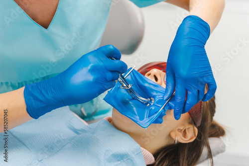 Close up shot of a young woman with her mouth open at the dentist in gloves.