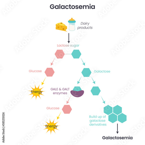 Galactosemia GALE GALK GALT Enzymatic Deficiency science vector illustration infographic