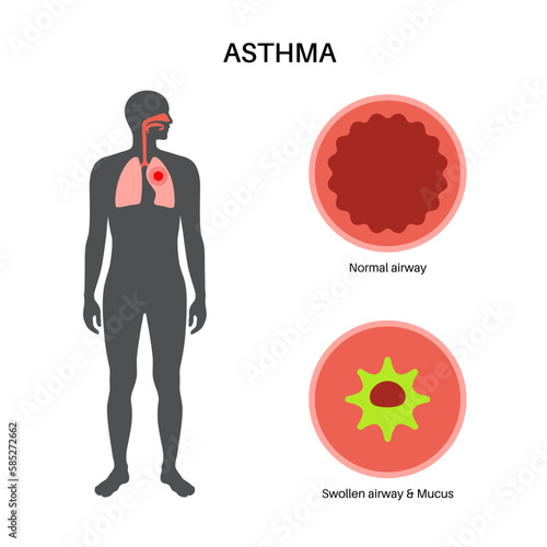 Asthma lung disease