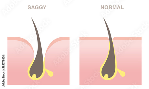 Skin cross section of pore types. Normal pore and saggy pore. Pale colored illustration in flat cartoon style.